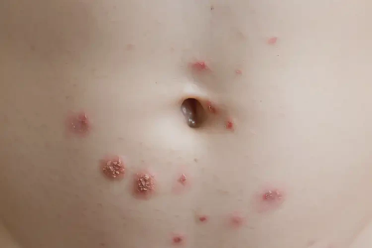 兒童肚子上容易起濕疹可以徹底自愈嗎(圖4)