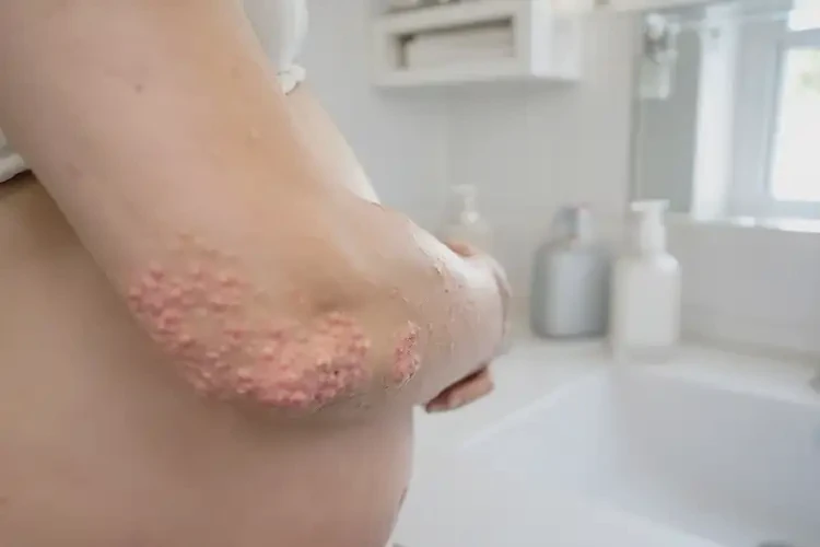 孕妇手臂容易起湿疹可以彻底自愈吗(图4)