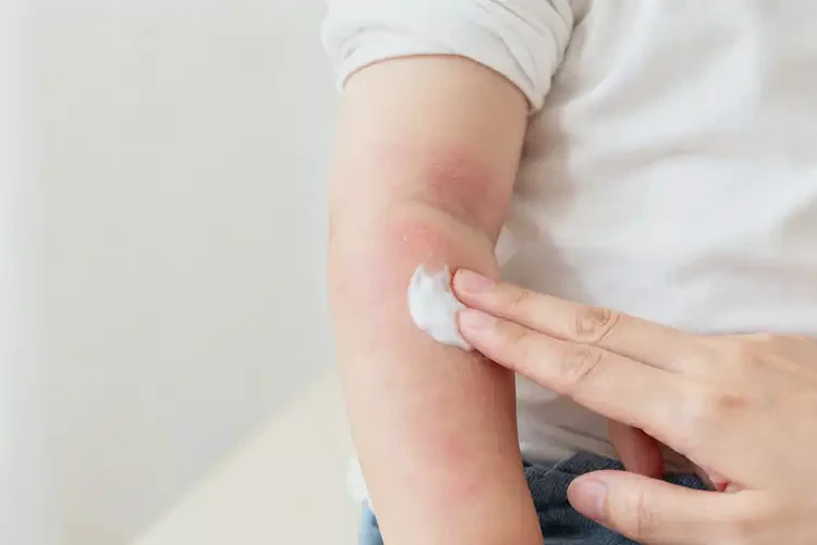 幼儿手臂上有湿疹不管它会自己好吗(图4)