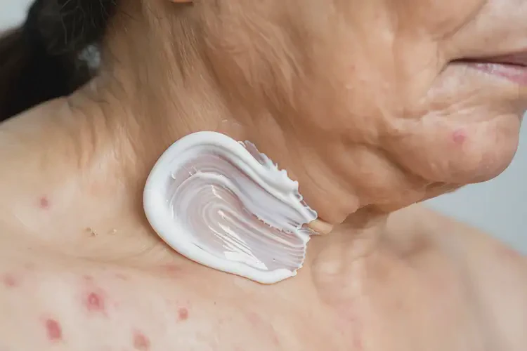 產(chǎn)婦脖子上出濕疹不管它會(huì)自己自愈嗎(圖2)