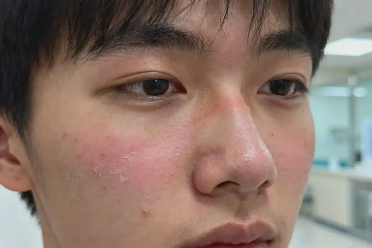 青年人面部有濕疹可不可以徹底自愈(圖1)