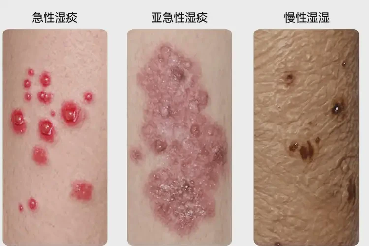 大學生手上經(jīng)常長濕疹能徹底自愈嗎(圖2)