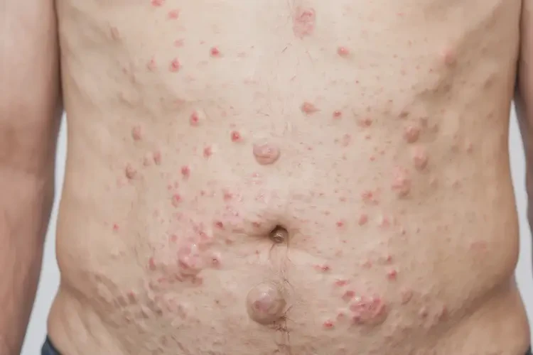 男性肚子经常长湿疹不管它会自己自愈吗(图4)