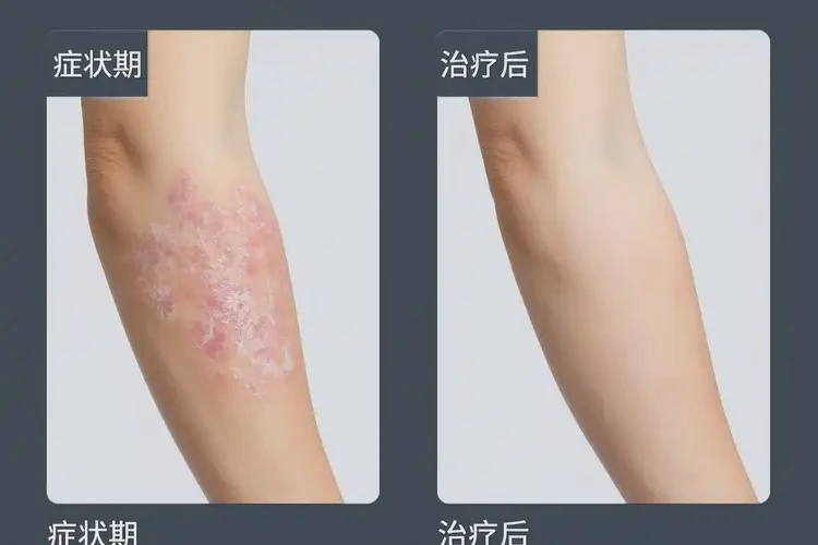 男性手上起濕疹能徹底自愈嗎(圖1)