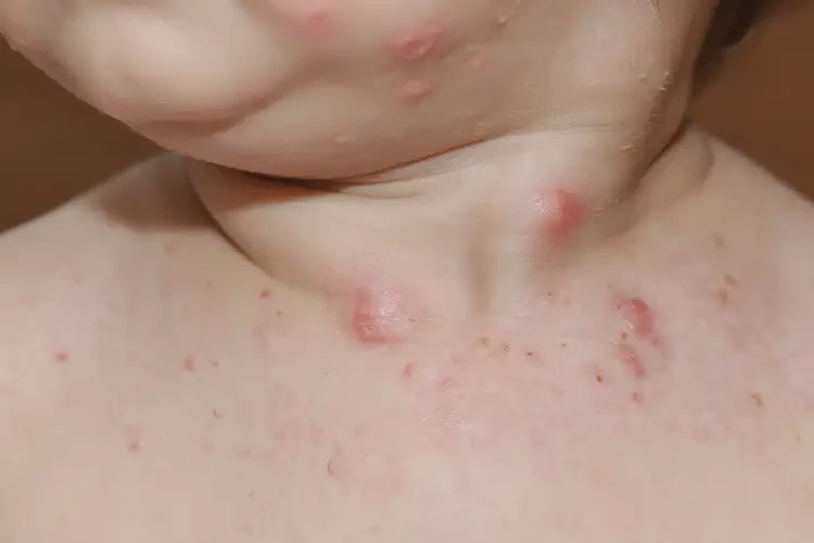 幼兒脖子上經(jīng)常長濕疹可以徹底自愈嗎(圖4)