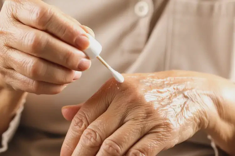 高齡老人手上經(jīng)常長(zhǎng)濕疹能不能根治(圖2)