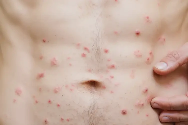 青年人肚子出濕疹可不可以徹底自愈(圖4)