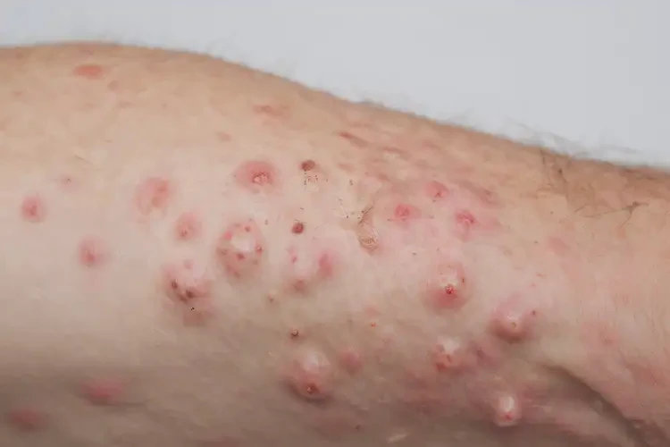 青年人手臂長濕疹能不能徹底自愈(圖4)