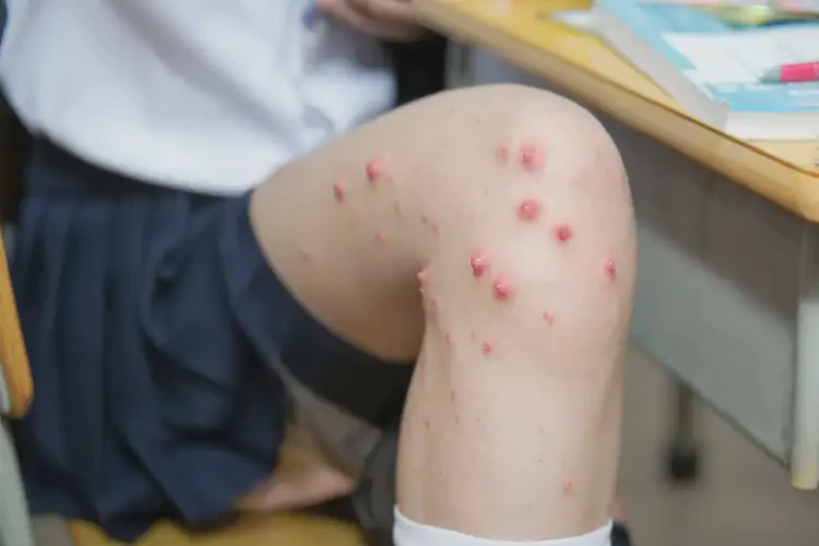 中學生小腿長濕疹不管它會自己自愈嗎(圖4)