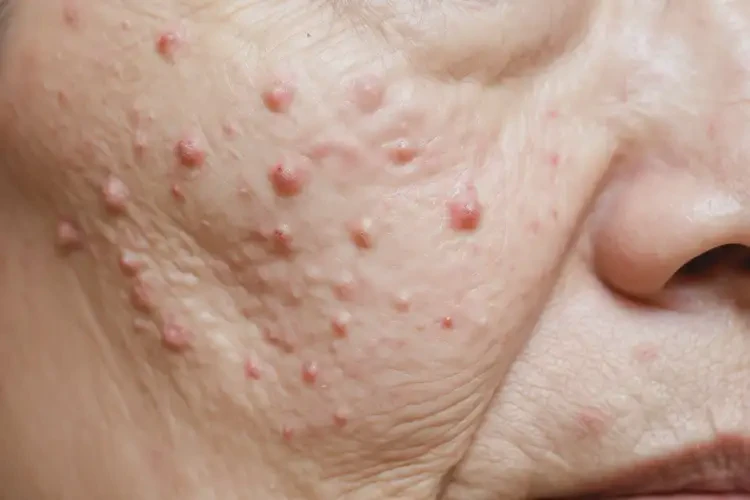 男性面部長(zhǎng)濕疹不管它會(huì)自己痊愈嗎(圖4)