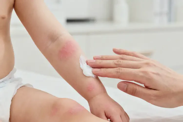 幼兒四肢出濕疹能夠徹底治愈嗎(圖2)