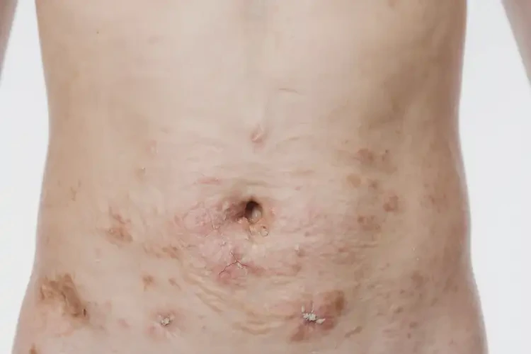 青少年肚子上偶尔长湿疹能靠自己自愈吗(图2)