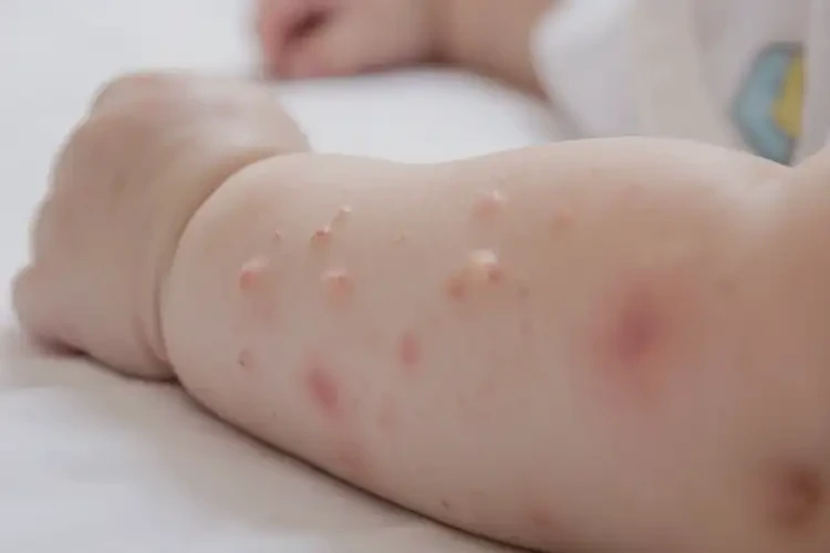 寶寶手臂上經(jīng)常長(zhǎng)濕疹可不可以徹底自愈(圖4)