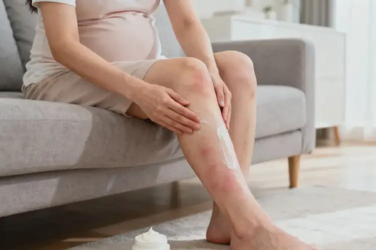 哺乳期媽媽小腿有濕疹能夠徹底治愈嗎(圖2)