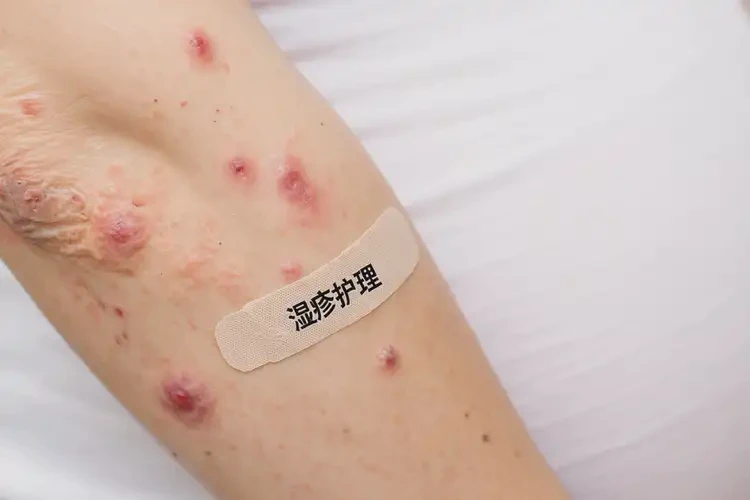 孕婦手臂上出濕疹能徹底自愈嗎(圖4)