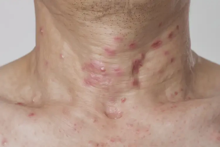 男人脖子出濕疹不管它會自己自愈嗎(圖4)