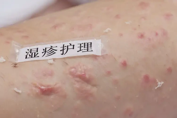 孩子身上出现湿疹能靠自己自愈吗(图4)