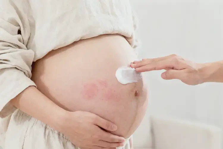 孕妇肚子上出现湿疹不管它会自己好吗(图3)