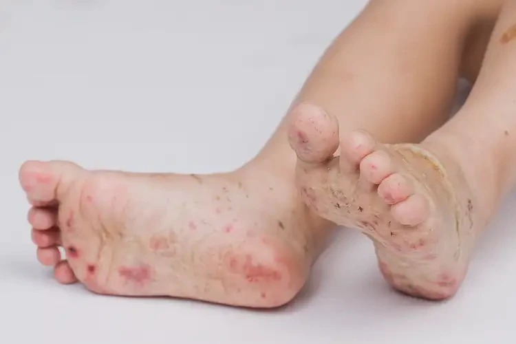 兒童腳上偶爾長(zhǎng)濕疹不管它會(huì)自己自愈嗎(圖3)