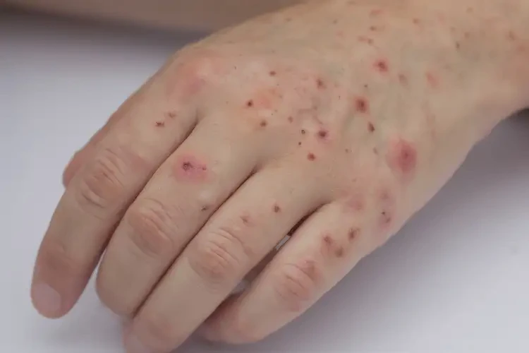 大學(xué)生手上起濕疹可以徹底自愈嗎(圖4)