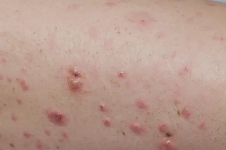 中学生小腿容易起湿疹不管它会自己痊愈吗(图4)