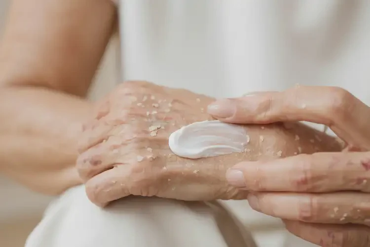 女性手上容易長濕疹不管它會自己好嗎(圖3)