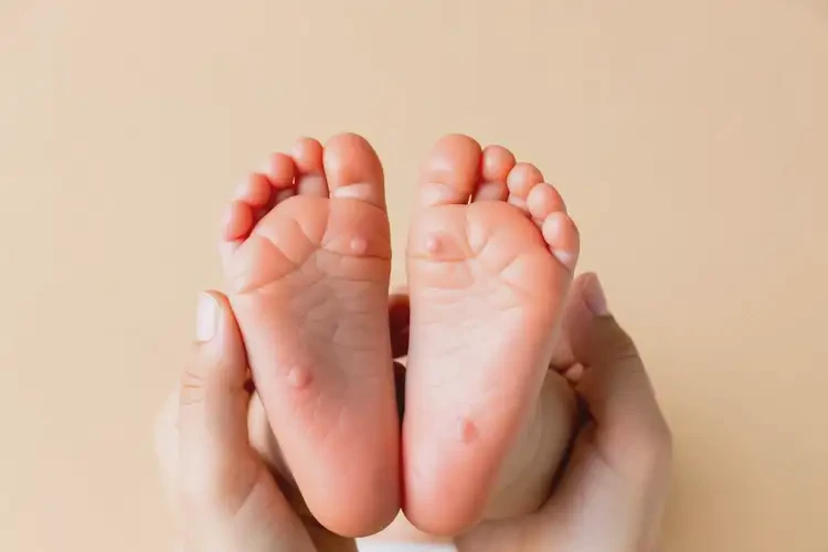 寶寶四肢容易長濕疹可以徹底自愈嗎(圖4)