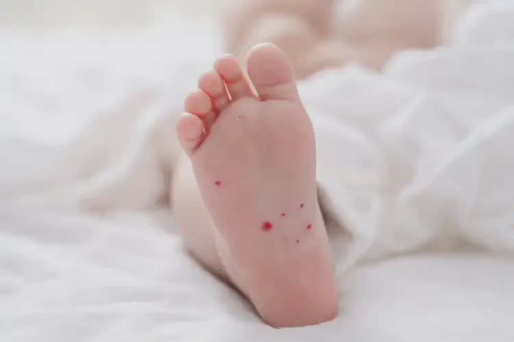 宝宝脚上偶尔长湿疹可以彻底自愈吗(图4)