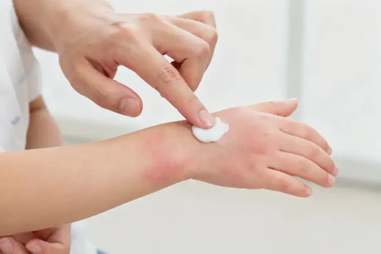 少兒手上有濕疹不管它會(huì)自己好嗎(圖4)