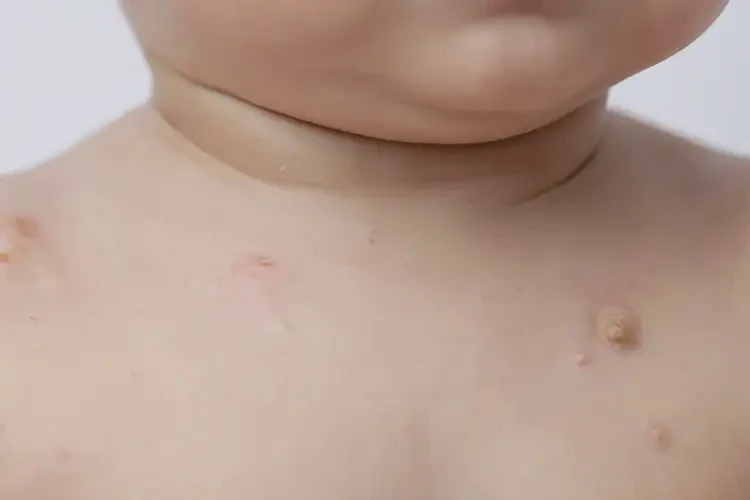 宝宝脖子有湿疹能靠自己自愈吗(图4)