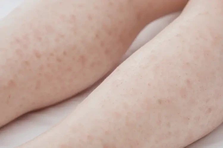 少儿四肢出湿疹能够彻底治愈吗(图4)