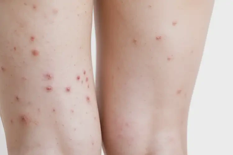 女人小腿偶爾起濕疹能夠徹底治愈嗎(圖4)