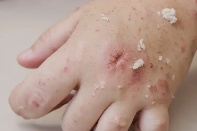 孩子手上出現(xiàn)濕疹能靠自己自愈嗎(圖4)