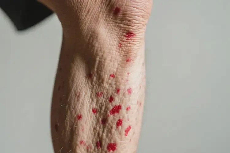 老年人小腿上經(jīng)常長(zhǎng)濕疹不管它會(huì)自己好嗎(圖4)