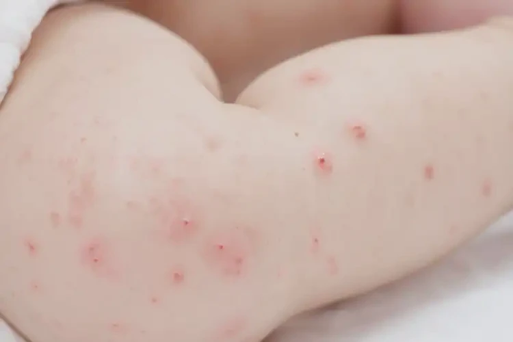 寶寶大腿上經(jīng)常長濕疹能徹底自愈嗎(圖4)