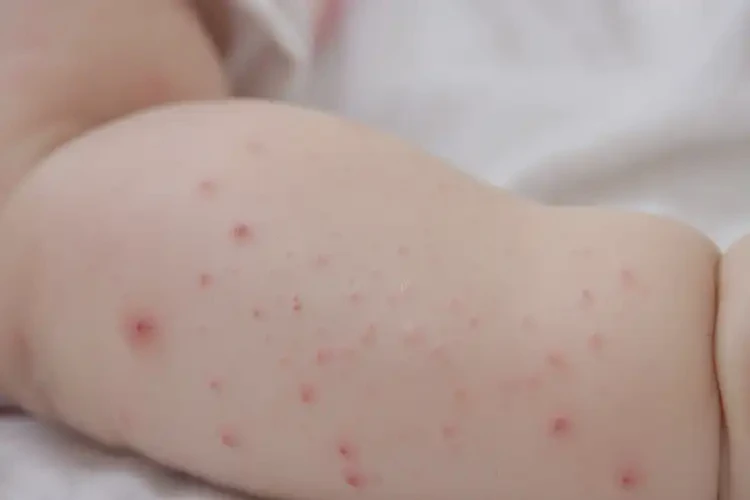 幼兒手臂長濕疹不管它會自己自愈嗎(圖4)