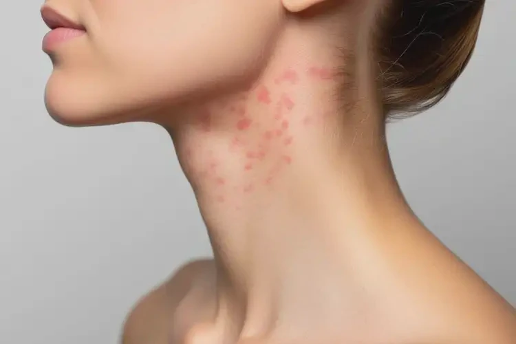 女人脖子偶爾起濕疹可不可以徹底自愈(圖2)