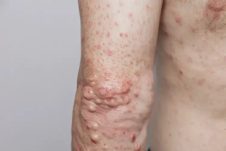 男人四肢有濕疹能徹底自愈嗎(圖2)