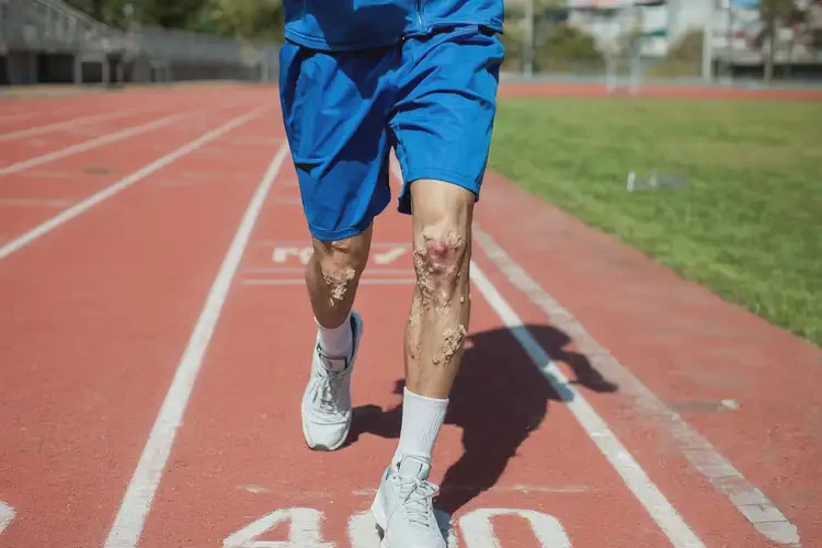 大学生小腿偶尔起湿疹能不能彻底自愈(图3)