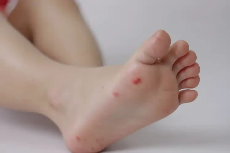 小兒腳上偶爾起濕疹能徹底自愈嗎(圖4)