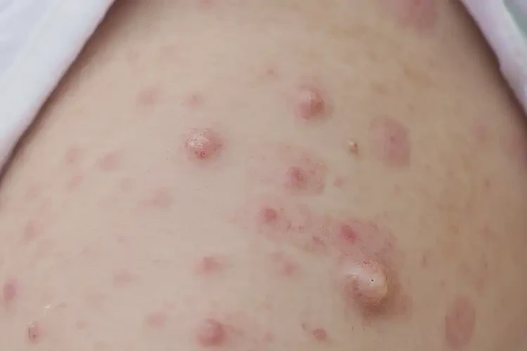 小学生屁股经常起湿疹不管它会自己自愈吗(图3)