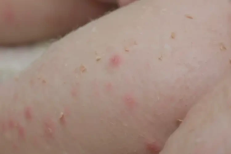 孩子小腿容易長濕疹可以徹底自愈嗎(圖4)