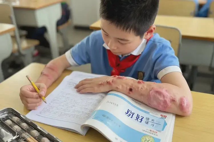 小學(xué)生手臂出濕疹能徹底自愈嗎(圖1)