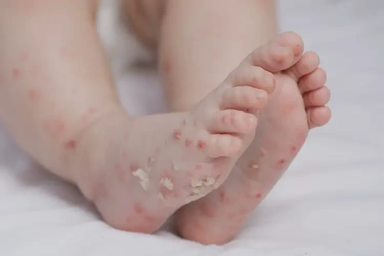 嬰幼兒腳上出現(xiàn)濕疹能夠徹底治愈嗎(圖4)