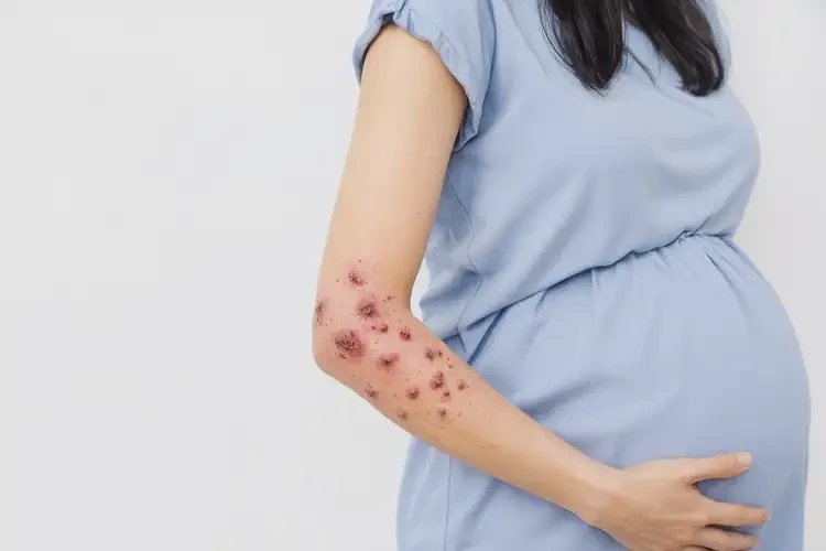 孕婦四肢起濕疹能夠徹底治愈嗎(圖4)