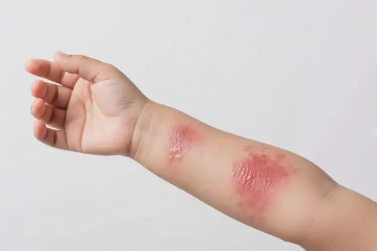 少兒手臂出濕疹可以徹底自愈嗎(圖2)