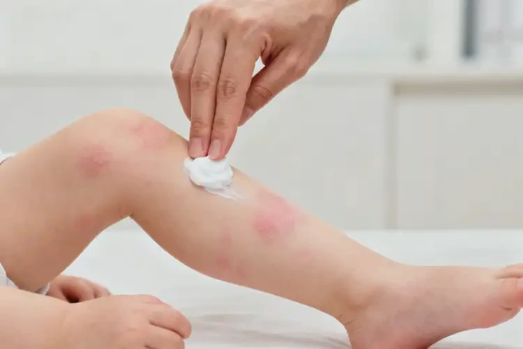 幼兒四肢出濕疹能夠徹底治愈嗎(圖4)