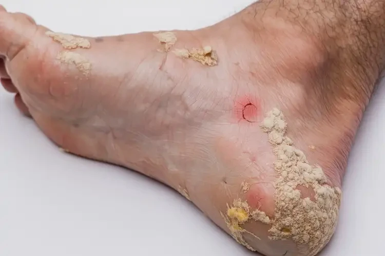 兒童腳上起濕疹能靠自己自愈嗎(圖3)