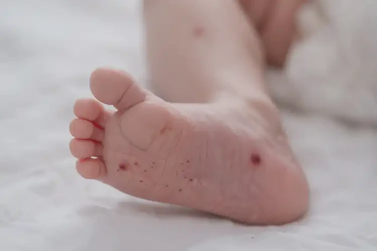 新生兒腳上有濕疹不管它會(huì)自己痊愈嗎(圖1)