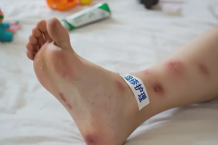 小兒腳上有濕疹能夠徹底治愈嗎(圖4)